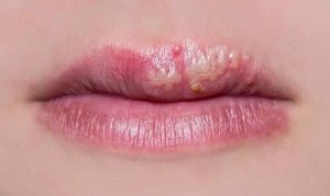 Tìm hiểu nguyên nhân khiến sau khi phun môi bị nổi mụn trắng